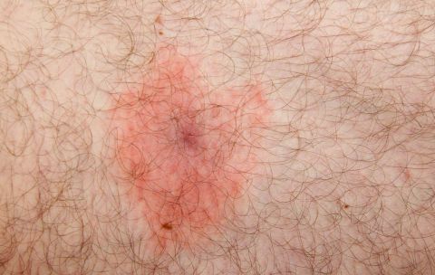 Borreliose St 480 Borreliose St 480