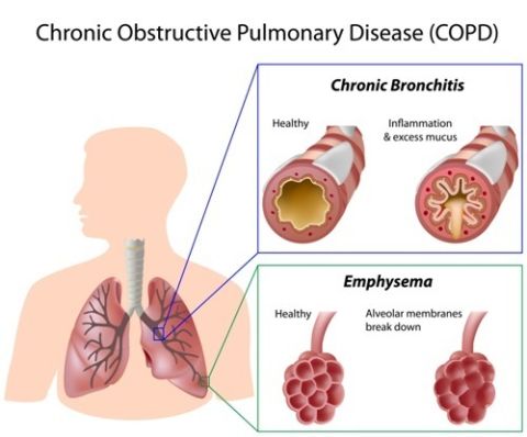 Copd Shutterstock 480x Copd Shutterstock 480x